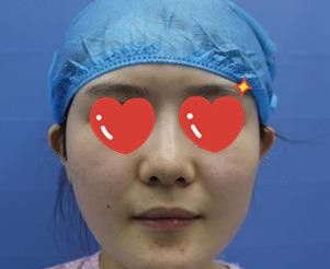 本来就是圆脸还被医生推荐做脂肪填充,想知道到底是什么鬼花1分钟看完这篇文章就了解了