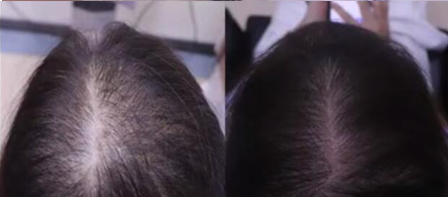 头发细软稀疏发缝变宽后,我是通过这种方式实现密发生发的效果的!