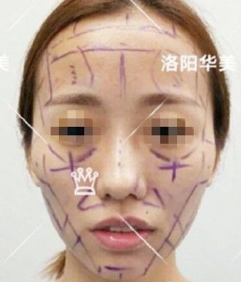 怕自体脂肪填充全脸很假的快速看这篇恢复很自然的图片对比效果来避坑