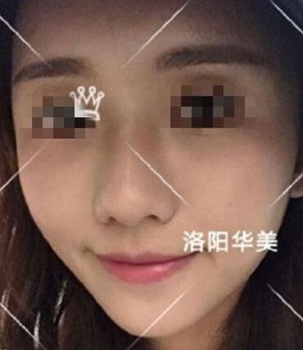 怕自体脂肪填充全脸很假的快速看这篇恢复很自然的图片对比效果来避坑 图2