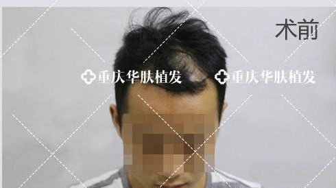 想看头顶稀疏脱发患者,植发后1-6个月的效果图吗?那就速来围观