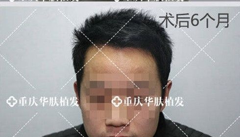 想看头顶稀疏脱发患者,植发后1-6个月的效果图吗?那就速来围观 图2