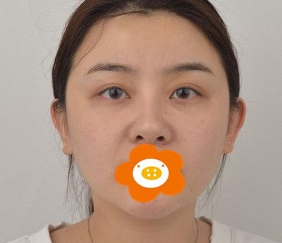 脸部做埋线提升的亲身经历总结:手术很安全术后也没有后遗症