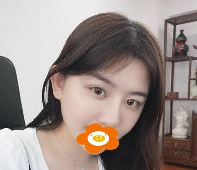 脸部做埋线提升的亲身经历总结:手术很安全术后也没有后遗症 图2