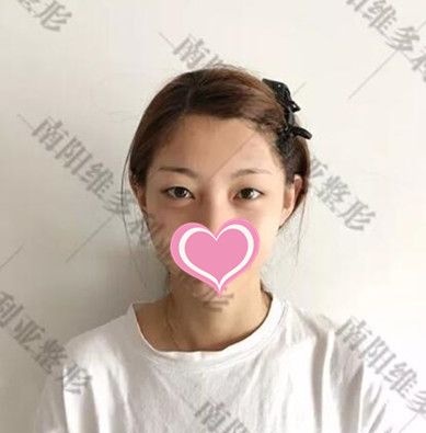 纠结双眼皮做哪个好后选了全切8mm手术恢复后效果你来评价