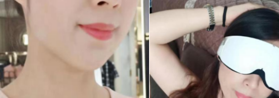 我用五年的时间来向大家证明假体垫下巴会发生磨骨和移位现象是谣言 案例图2