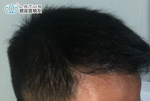 做头顶加密植发三个月没看到效果,我还以为是植发失败了...... 图2