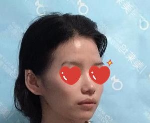 “颧弓外扩”不一定要做手术才能改善,我就只做了自体脂肪面部填充就达到了想要的效果