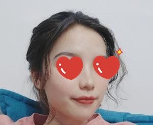 “颧弓外扩”不一定要做手术才能改善,我就只做了自体脂肪面部填充就达到了想要的效果 图2