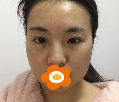面颊,双下巴,下颌缘3个部位一起做面部吸脂,赶走了我的大脸盘子!