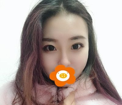 面颊,双下巴,下颌缘3个部位一起做面部吸脂，赶走了我的大脸盘子！ 案例图2
