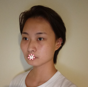 之前颧骨突出做自体脂肪填充后脸型顺眼了很多 也没感染或其他后遗症