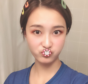 之前颧骨突出做自体脂肪填充后脸型顺眼了很多 也没感染或其他后遗症 案例图2