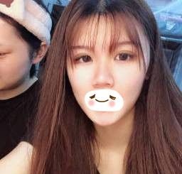 没做过眼综合的宝宝可以参考下我做全切双眼皮+上睑去脂+开内眼角的术后效果 图2
