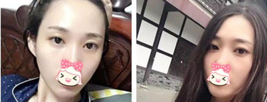 老实说我也惊讶头一回做内切祛眼袋手术没失败没凹陷也看不出疤 图2