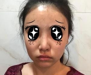 只想做个假体隆鼻为啥医生非让我做个半肋软骨隆鼻,难道就是为了多挣钱