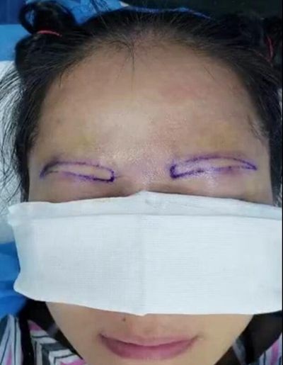 种植眉毛亲身经历手术视频来喽!此次一共提取了后脑勺300多个毛囊
