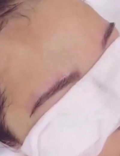 种植眉毛亲身经历手术视频来喽!此次一共提取了后脑勺300多个毛囊 图2