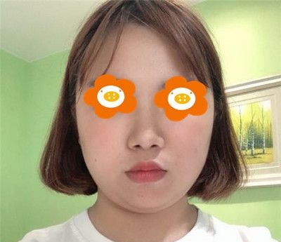 黄金微雕瘦双下巴恢复期要多久?我带了2个多月绷带尖下巴都出来了