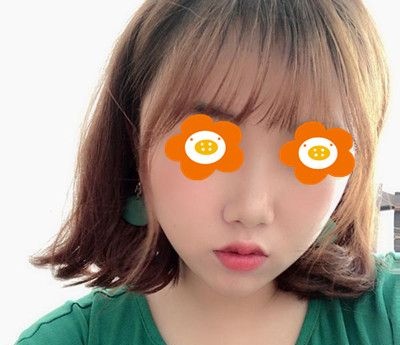 黄金微雕瘦双下巴恢复期要多久?我带了2个多月绷带尖下巴都出来了 图2