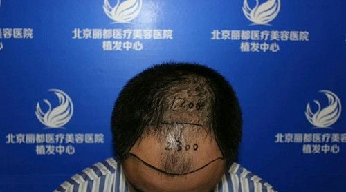 前额头发稀疏脱发做大面积植发3500毛囊单位后魅力“发”生