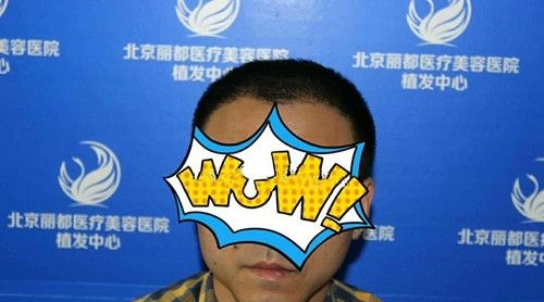 前额头发稀疏脱发做大面积植发3500毛囊单位后魅力“发”生 图2