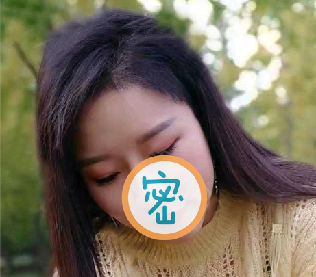 刚做完发际线种植后一星期头发短比较难看,2个月后长长了就好多了 图2