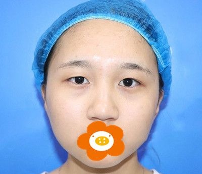 20岁妹子做双眼皮手术真实经历心得,恢复半年后形状大小都很满意!