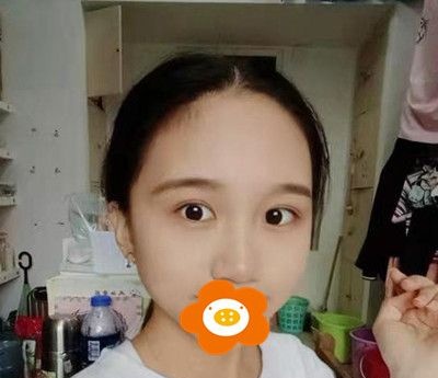 20岁妹子做双眼皮手术真实经历心得,恢复半年后形状大小都很满意! 图2