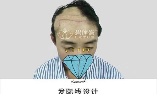 头部疤痕植发者恢复效果分享:术后2个月3个月每天都有不一样的变化