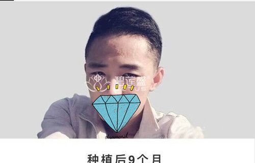 头部疤痕植发者恢复效果分享:术后2个月3个月每天都有不一样的变化 图2