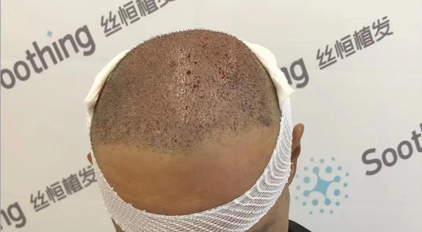 重新面诊设计后,医生决定微针加密3000毛囊单位拯救植发失败案例 图2