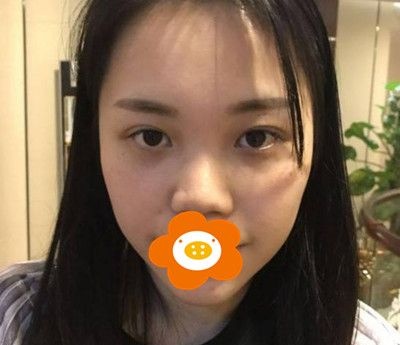 我做硅胶假体隆鼻半年后形态自然,轻微晃动揉捏很正常!