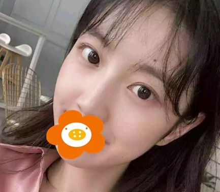 我做硅胶假体隆鼻半年后形态自然,轻微晃动揉捏很正常! 图2