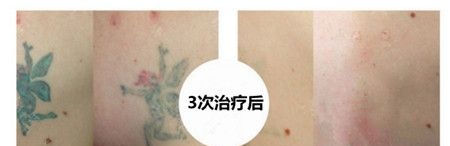 如果你还怀疑皮秒是否能洗干净纹身?他恢复后的效果图片就是答案