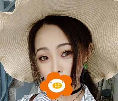 硅胶假体+耳软骨垫鼻尖恢复全过程,三个月后没有不适也不怕揉捏! 图2