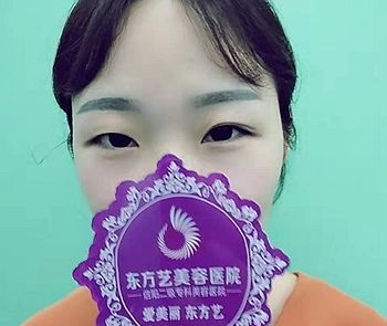 割7毫米双眼皮二个月恢复后的实际宽度刚刚好