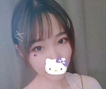 割7毫米双眼皮二个月恢复后的实际宽度刚刚好 图2