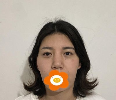 谁说玻尿酸填充脸颊后脸会变宽?我注射爱芙莱丰面颊半年面部饱满自然！！！