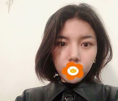 谁说玻尿酸填充脸颊后脸会变宽?我注射爱芙莱丰面颊半年面部饱满自然！！！ 案例图2