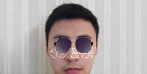 我属于前额m型脱发,在使用米诺地尔无果后选择了前额发际线种植! 图2