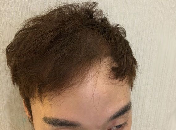 打听到该医院植发团队技术比较好,我专程到北京做了2000毛囊单位的头顶加密种植