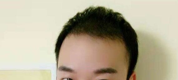 打听到该医院植发团队技术比较好,我专程到北京做了2000毛囊单位的头顶加密种植 图2