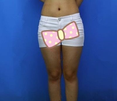我的腿太粗做大腿环吸抽了1500ml脂肪分享下亲身经历!!!