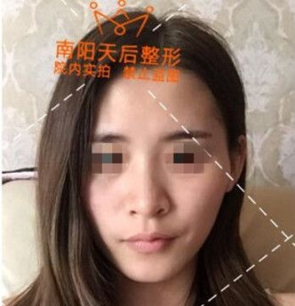 今日份肋软骨隆鼻效果干货:从隆鼻流程到三个月变化图全部奉上