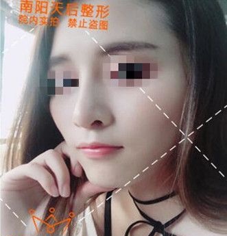 今日份肋软骨隆鼻效果干货:从隆鼻流程到三个月变化图全部奉上 图2